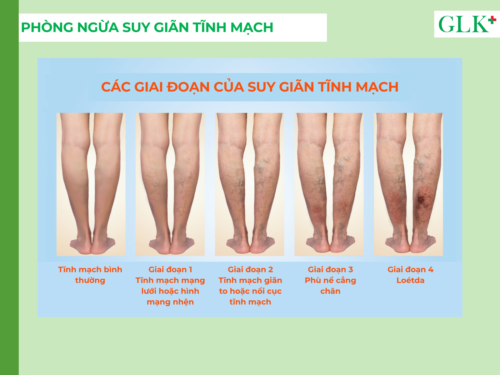 CHỦ ĐỀ: SUY GIÃN TĨNH MẠCH & HUYẾT KHỐI TĨNH MẠCH - PHẦN 2