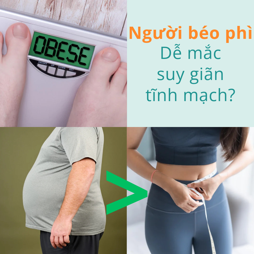 Người béo phì có nguy cơ mắc suy giãn tĩnh mạch cao hơn người có cân nặng bình thường không?